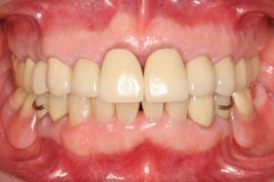 Full Mouth Rehab with Partial Denture After