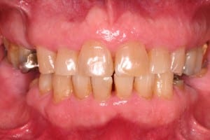 Full Mouth Rehab with Partial Denture Before