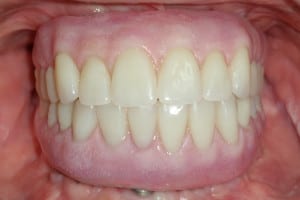 Hybrid with Orthognathic Surgery After