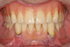 Immediate implants with prior Lower partial denture before