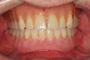Immediate lower denture with Implants after