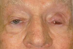 Maxillofacial Ocular Prosthesis Before